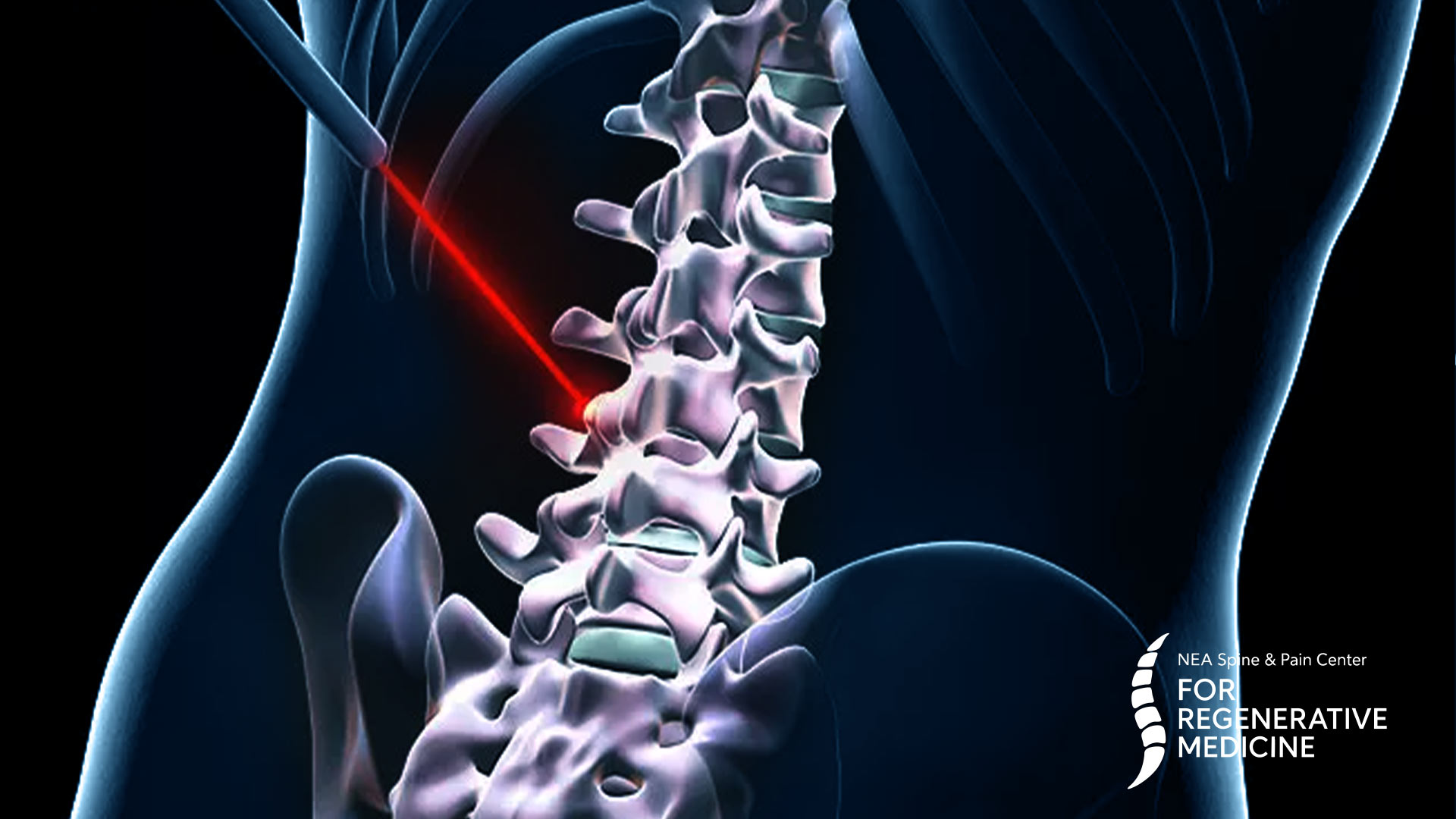 Endoscopic-Spine-Procedures
