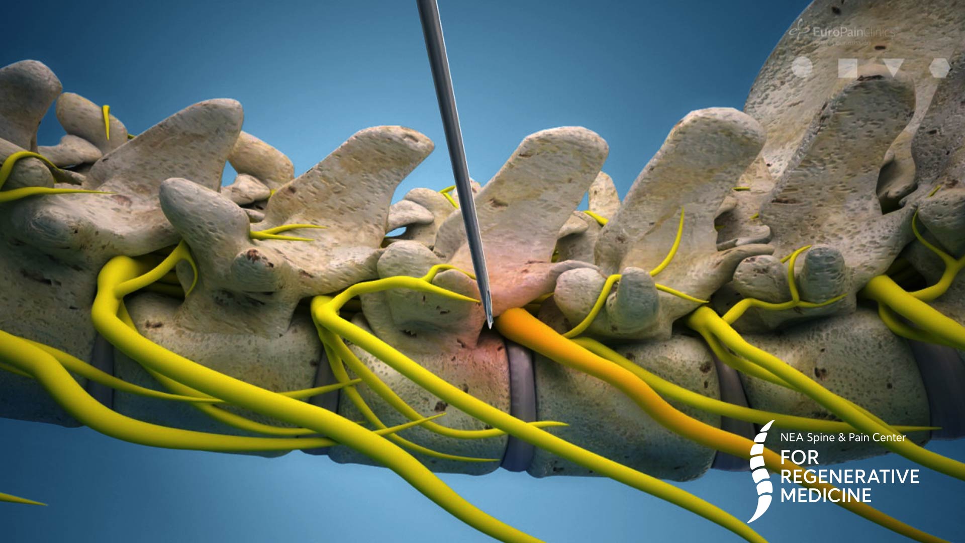 Epidural-Adhesiolysis