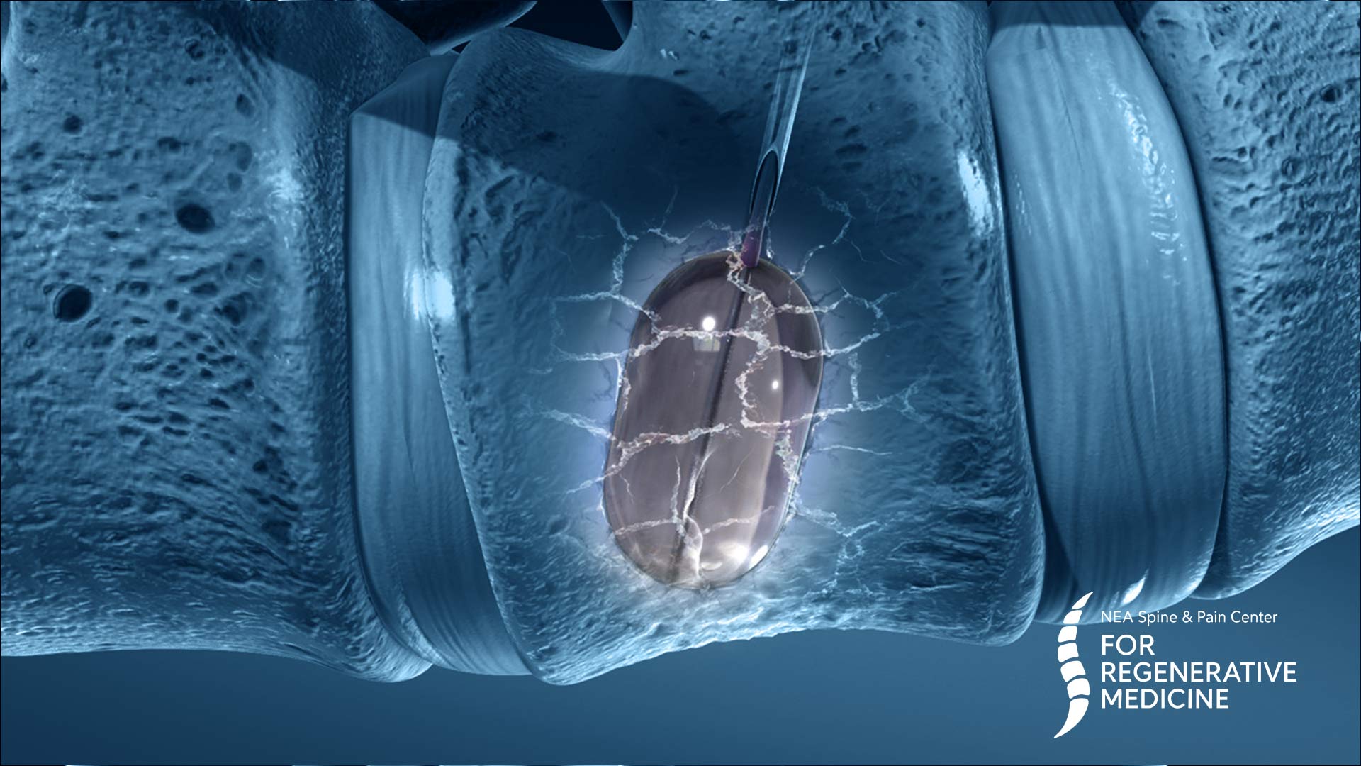 Kyphoplasty-And-Vertebroplasty
