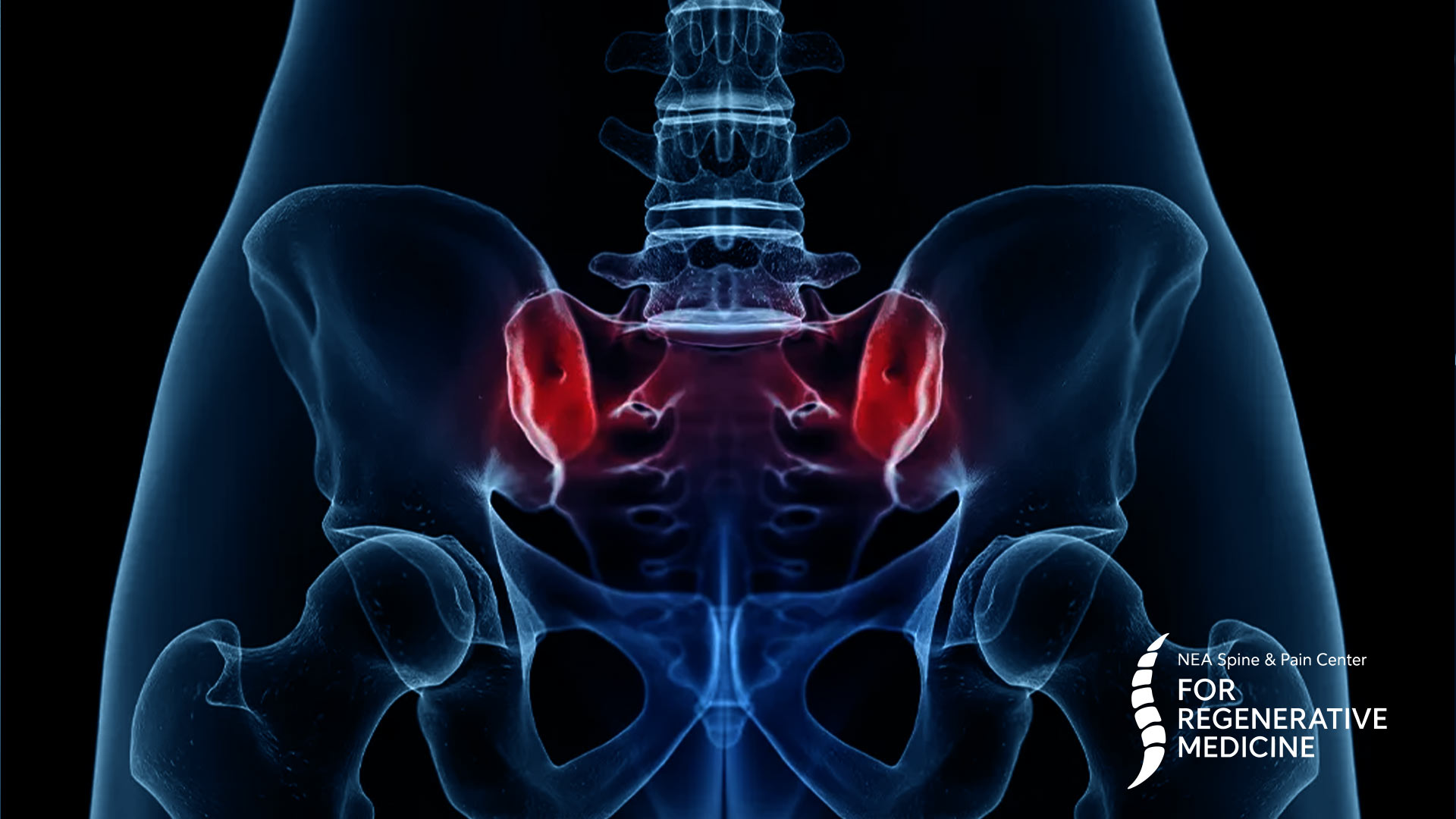 Minimally-Invasive-Sacroiliac-Joint-Fusion