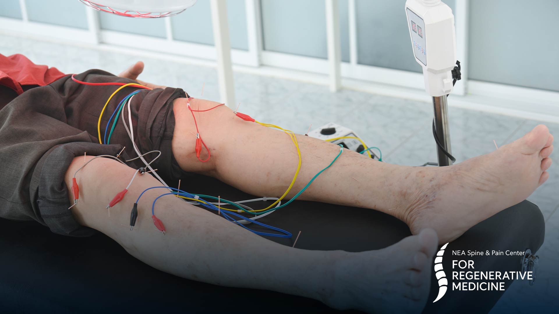 Peripheral-nerve-stimulation-implantation