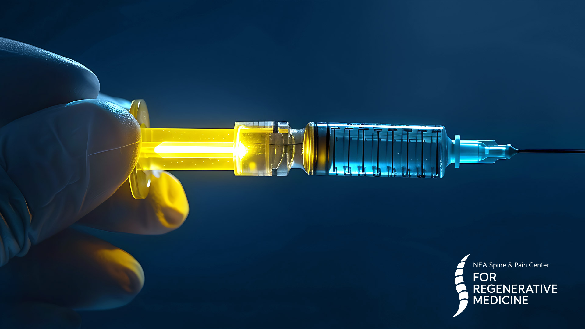 Platelet-Rich-Plasma-treatment