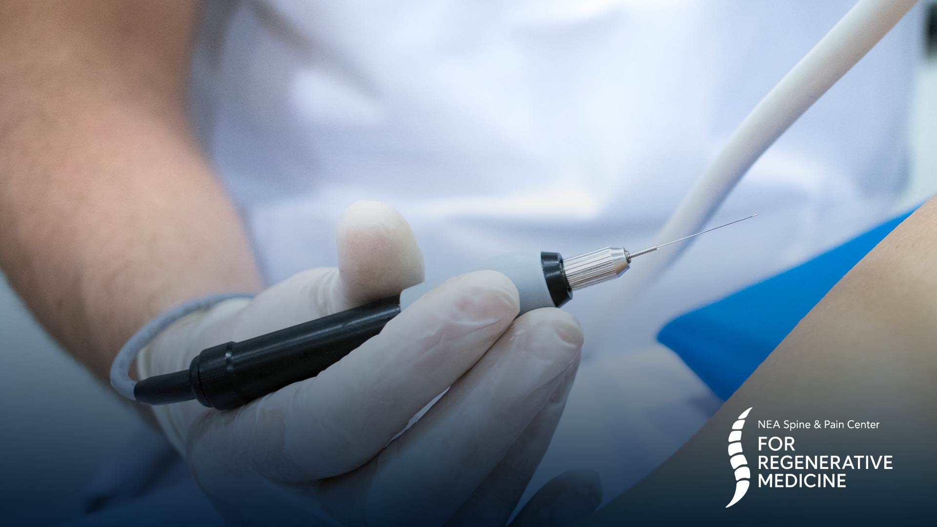 Radiofrequency Ablation (RFA)