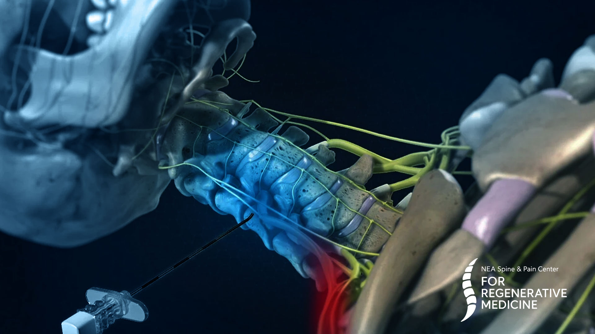 epidural-steroid-injections